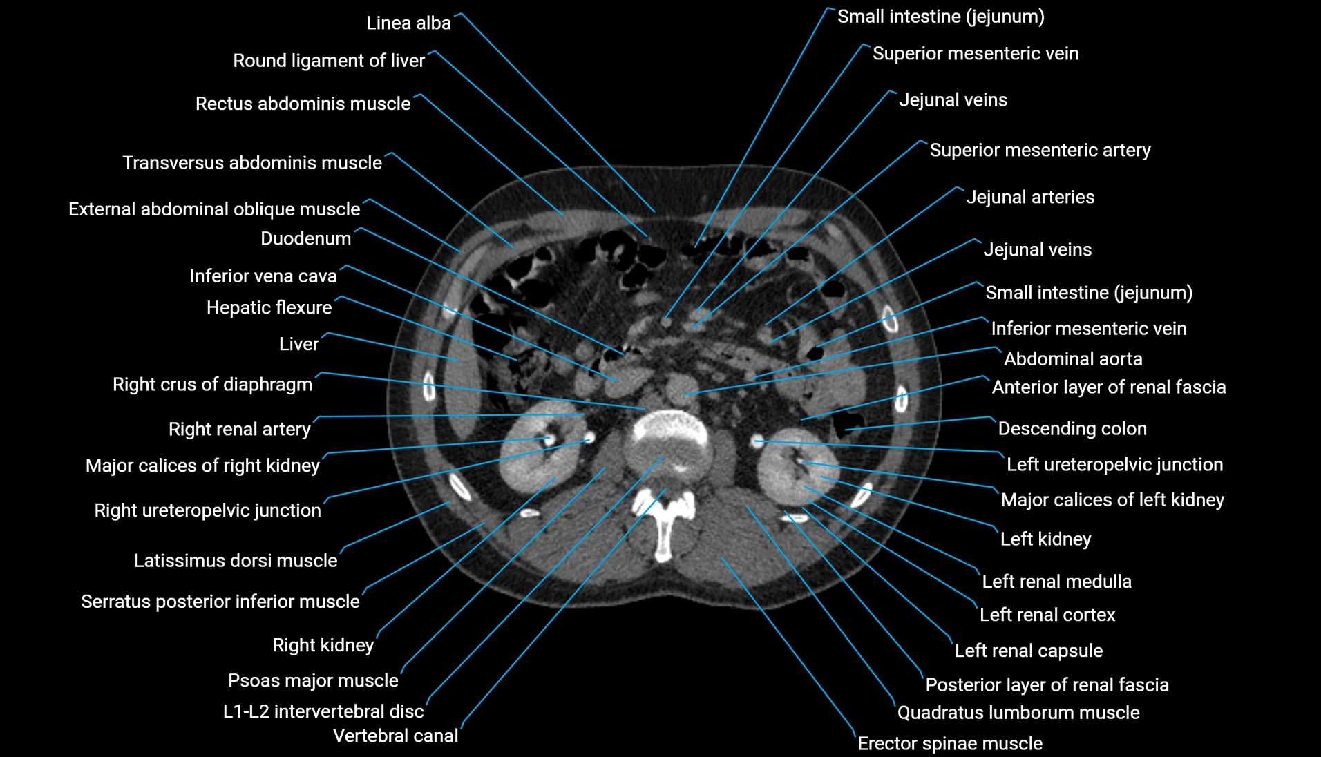 CT urogram axial cross sectional anatomy  labelled radiology image-00107.webp